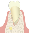 抜歯