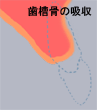 歯を失った後の歯槽骨の吸収
