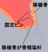 GBRで骨補填材を置く工程