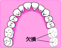 義歯の設計